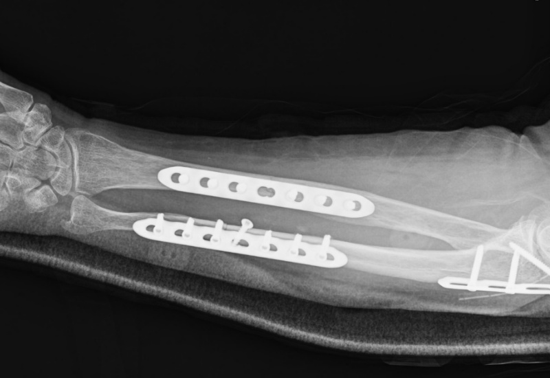 Orif For Olecranon Fractures Simple Olecranon Fractur vrogue.co