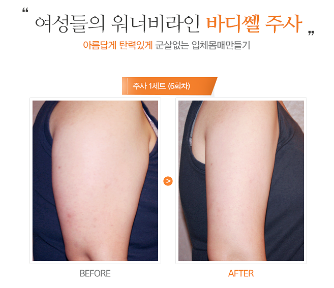 강릉 비만주사 바디쎌주사로 날씬하게 